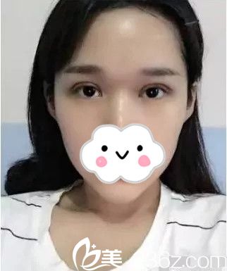 術(shù)后3天 術(shù)后3天