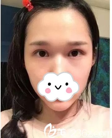 拉著老媽陪我去韓國尚美佳整形做了切開雙眼皮，老媽說我變的比之前更可愛了