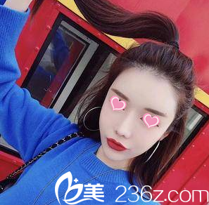 北京美萊黃杰臉部脂肪填充案例第48天效果 北京美萊黃杰臉部脂肪填充案例第48天效果