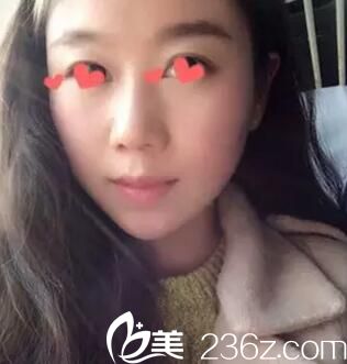 在沈陽名流割雙眼皮術(shù)前照 在沈陽名流割雙眼皮術(shù)前照