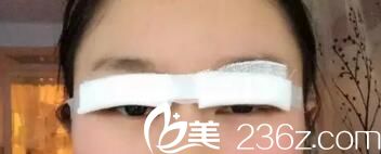 全切雙眼皮術(shù)后當(dāng)天 全切雙眼皮術(shù)后當(dāng)天