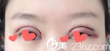 在名流割雙眼皮術(shù)后第二天 在名流割雙眼皮術(shù)后第二天