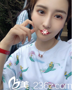 我的雙眼皮不對稱重瞼線不明顯去了韓國NYPS整形金均泰那兒做完雙眼皮修復(fù)很驚喜！