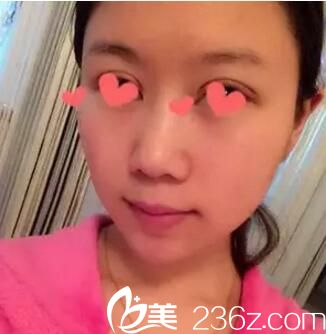 割雙眼皮術(shù)后第五天拆線 割雙眼皮術(shù)后第五天拆線