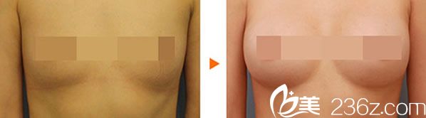 華山整形自體脂肪隆胸案例