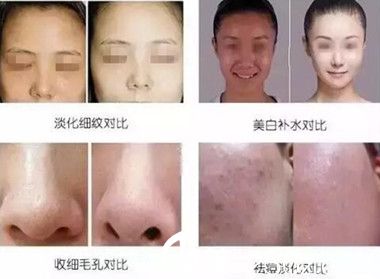 小氣泡解決面部肌膚問題真人展示