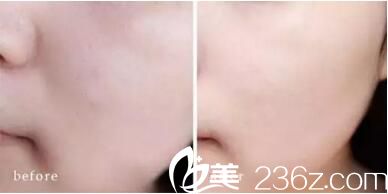小氣泡清潔面部前后效果對比