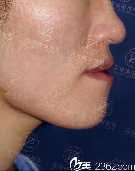 被青春痘瘢痕困擾多年的我在武漢正璞找到了去痘坑的好辦法