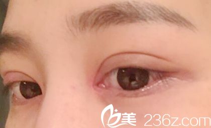 南陽全切雙眼皮