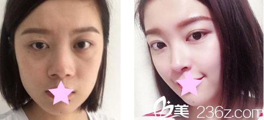 蘭州亞韓整形鼻綜合隆鼻+去眼袋前后效果對(duì)比