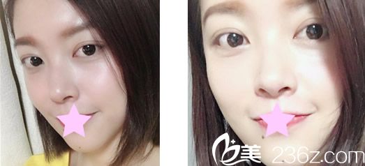 綜合隆鼻一個(gè)月后的恢復(fù)效果