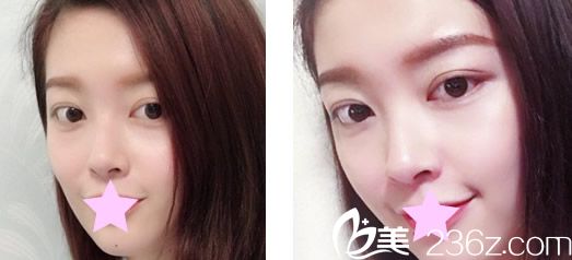 我找蘭州亞韓割了雙眼皮后又讓她做了鼻綜合隆鼻+去眼袋手術(shù) 效果是一如既往的好