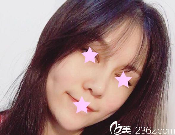 自體脂肪填充全臉半個月效果