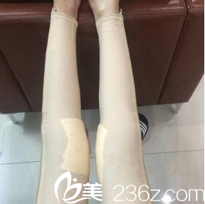 北京美萊共振吸脂第8天效果