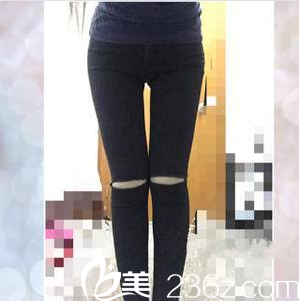 北京美萊黃杰共振吸脂案例第35天效果