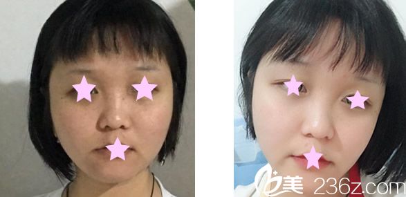 蘭州亞韓激光祛斑前后效果對比