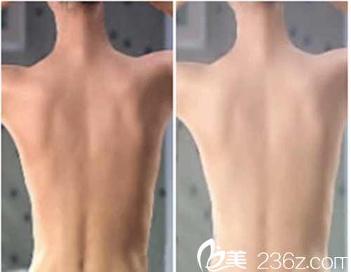 韓國延世SK整形醫(yī)院注射案例對比效果