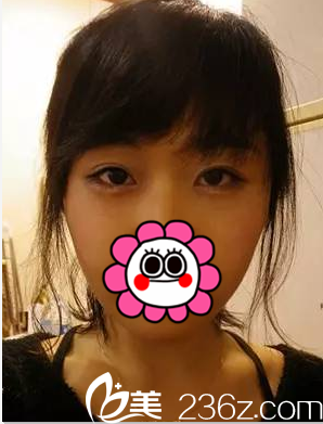 在北京美萊做玻尿酸豐臥蠶注射瘦臉第2天樣子