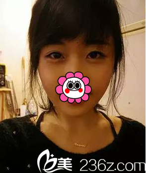 找周福田做玻尿酸豐臥蠶注射瘦臉第5天