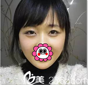 北京美萊玻尿酸豐臥蠶注射瘦臉案例