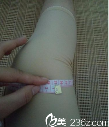 在北京知音做水動(dòng)力腿部吸脂第8天 在北京知音做水動(dòng)力腿部吸脂第8天