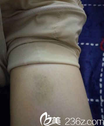 做腿部吸脂5天 做腿部吸脂5天