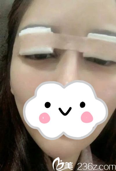 雙眼皮手術(shù)修復(fù)后第1天