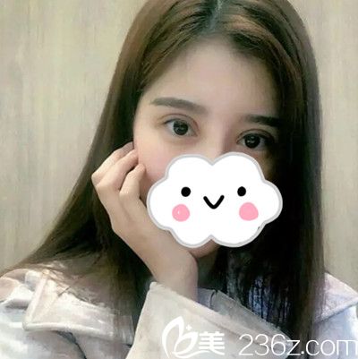 安恩模院長給我做雙眼皮修復(fù)手術(shù)6天了