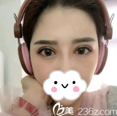 雙眼皮修復(fù)14天后恢復(fù)情況