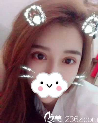 韓國美作整形醫(yī)院雙眼皮修復(fù)手術(shù)案例