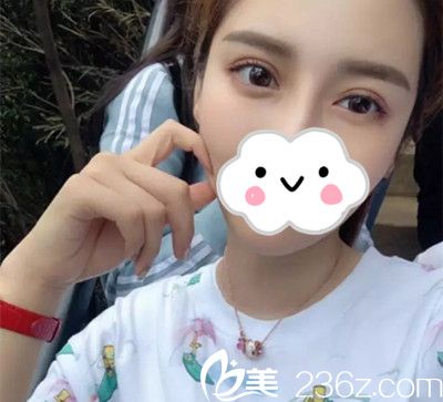 雙眼皮修復(fù)一個(gè)月后