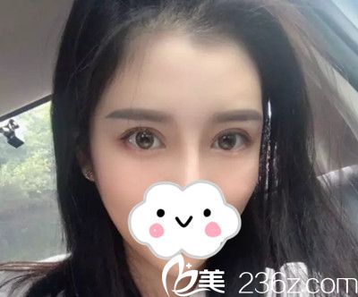 韓國美作整形醫(yī)院安恩模院長給我做雙眼皮修復(fù)手術(shù)后，我算是擺脫了大小眼