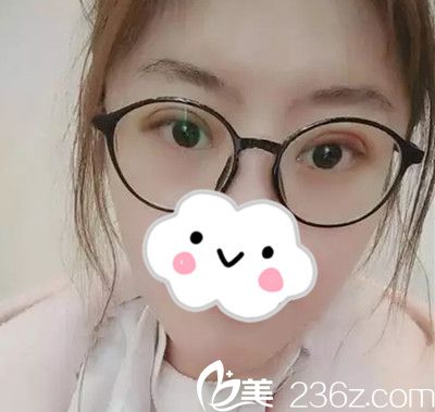 雙眼皮手術(shù)7天后 雙眼皮手術(shù)7天后