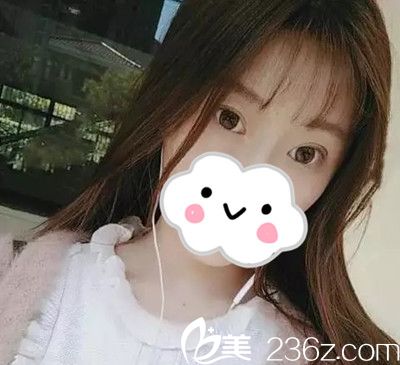 崔錫勛院長雙眼皮手術(shù)案例分享 崔錫勛院長雙眼皮手術(shù)案例分享