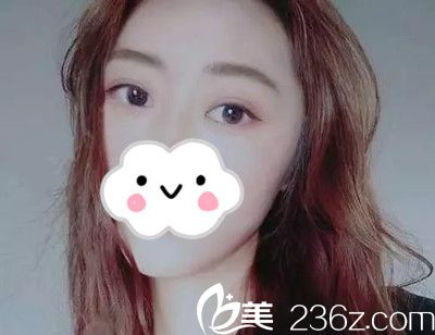 韓國狎鷗亭艾薇整形外科雙眼皮手術(shù)案例 韓國狎鷗亭艾薇整形外科雙眼皮手術(shù)案例