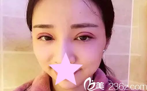 全切雙眼皮術(shù)后第二天 全切雙眼皮術(shù)后第二天