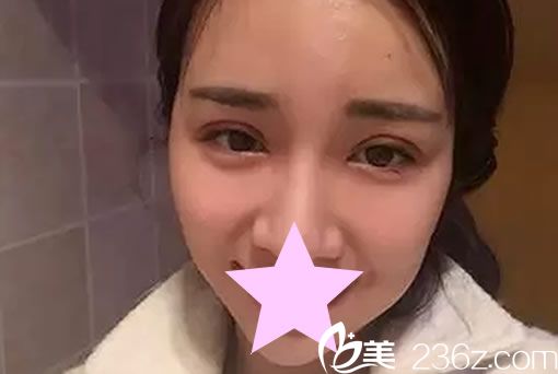 全切雙眼皮7天恢復(fù)圖片 全切雙眼皮7天恢復(fù)圖片