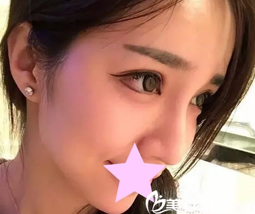 雙眼皮10天恢復(fù)圖 雙眼皮10天恢復(fù)圖