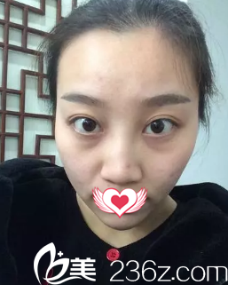 術前鼻梁塌平 術前鼻梁塌平