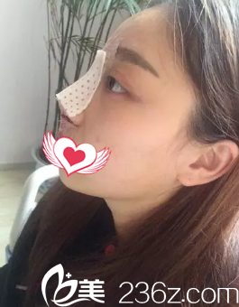 剛做完隆鼻手術鼻子微腫 剛做完隆鼻手術鼻子微腫