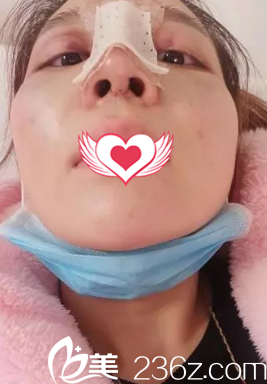 假體隆鼻5天后手術痕跡恢復不明顯 假體隆鼻5天后手術痕跡恢復不明顯