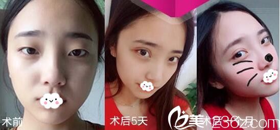 淮北微悅雙眼皮恢復(fù)過程圖