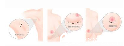 假體隆胸手術(shù)切口 假體隆胸手術(shù)切口