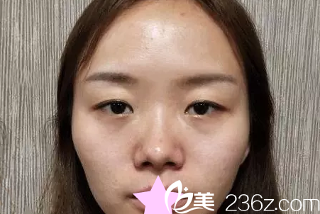 呼市京美整形雙眼皮整形失敗修復(fù)+隆鼻前 呼市京美整形雙眼皮整形失敗修復(fù)+隆鼻前