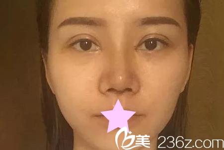 全切雙眼皮+綜合隆鼻第5天 全切雙眼皮+綜合隆鼻第5天