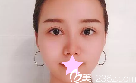 全切雙眼皮+綜合隆鼻半個月 全切雙眼皮+綜合隆鼻半個月