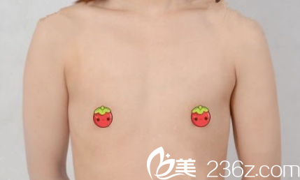 呼市京美整形假體隆胸+自體脂肪隆胸前 呼市京美整形假體隆胸+自體脂肪隆胸前