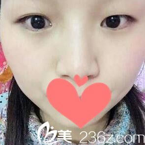 做雙眼皮+開眼角術(shù)前照 做雙眼皮+開眼角術(shù)前照