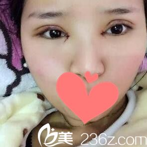 在韓國BCI做眼綜合術(shù)后第3天照 在韓國BCI做眼綜合術(shù)后第3天照