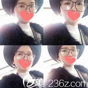 雙眼皮+開眼角術(shù)后一周拆線 雙眼皮+開眼角術(shù)后一周拆線